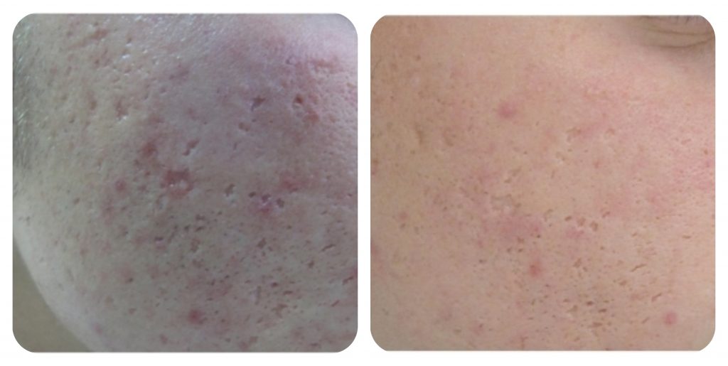 Dermabrasion for acne scars