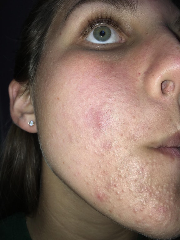 Microdermabrasion for severe acne