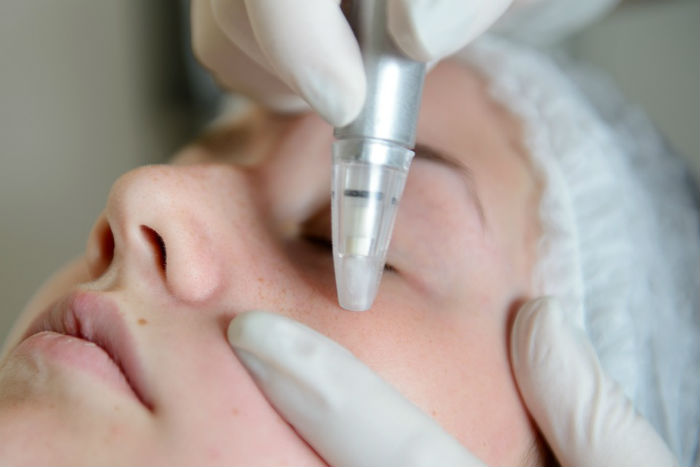 Microdermabrasion for acne fix