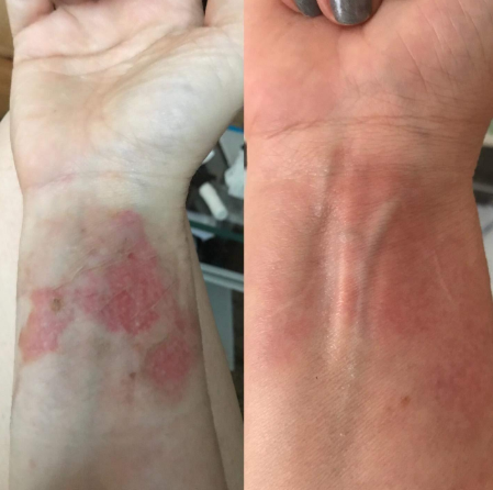 Burn scar on wrist progress