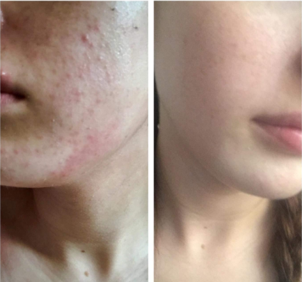 Puriderma for facial scars