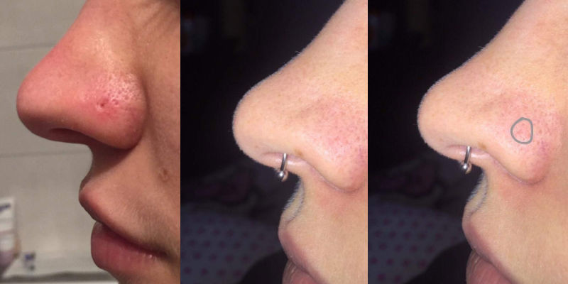 Puriderma piercing mark