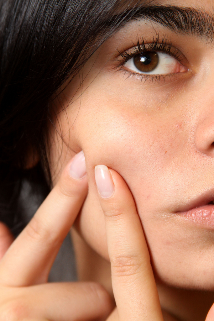 Pimple extraction