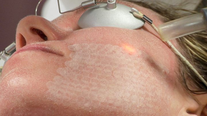 laser scar removal