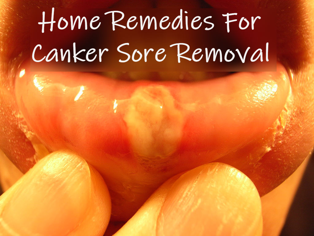 DIY Canker Sore Treatments